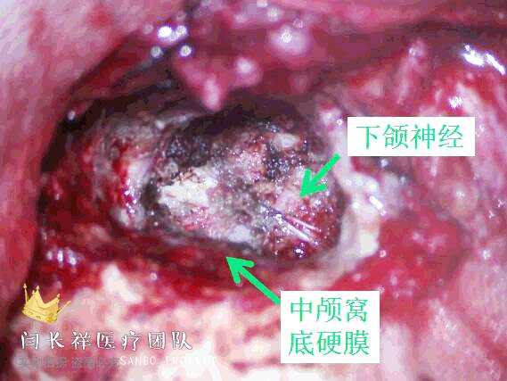 烦人的耳鸣,烦人耳鸣