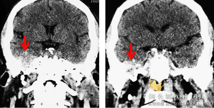 烦人的耳鸣,烦人耳鸣