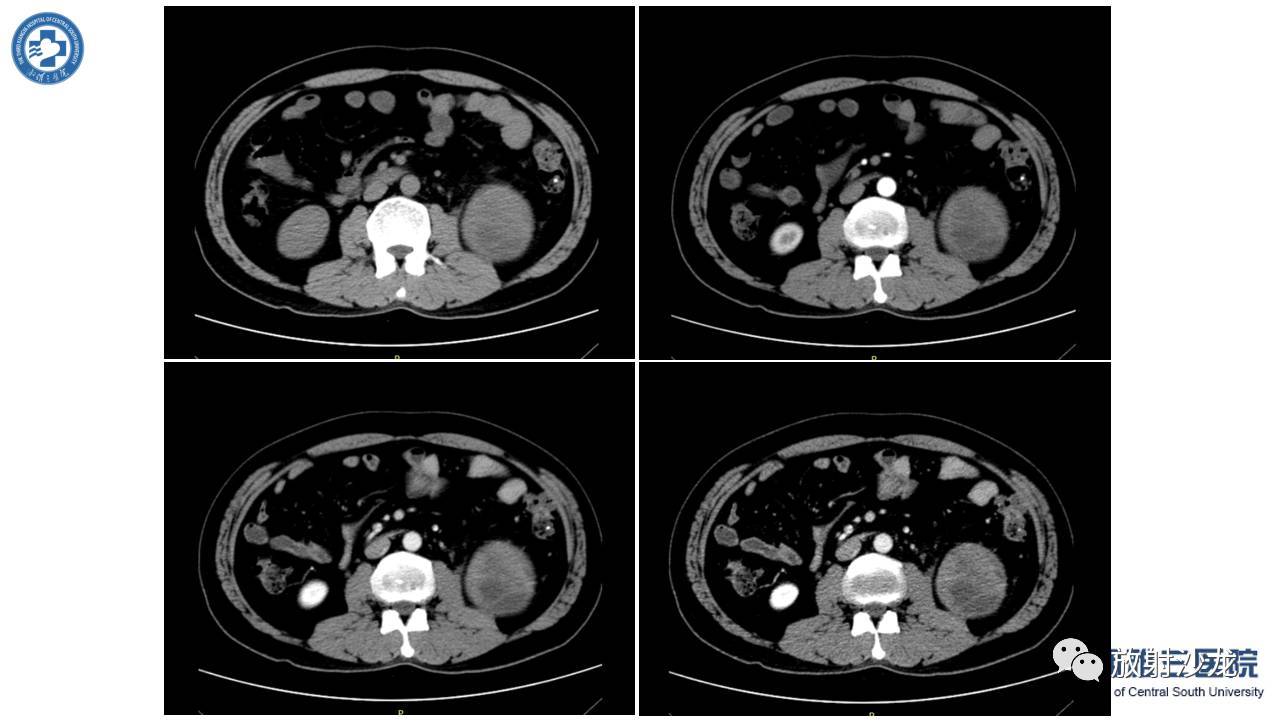 「每日一例｜489例」男，左侧腰部撞伤后疼痛3月