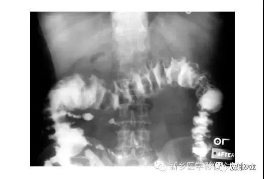 详细腹部平片解剖+正常表现+读片技巧+病例分析
