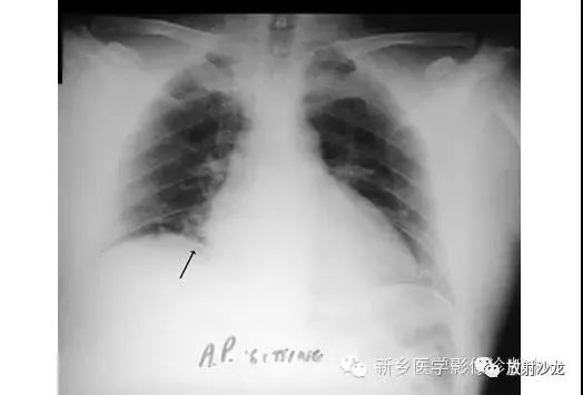 详细腹部平片解剖+正常表现+读片技巧+病例分析