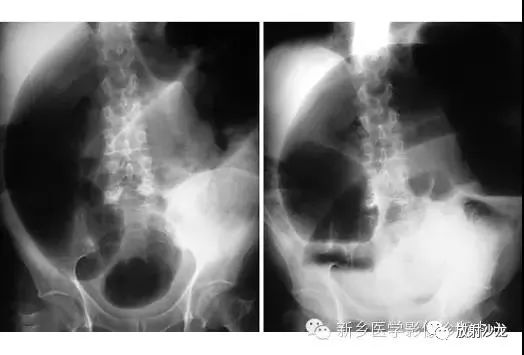 详细腹部平片解剖+正常表现+读片技巧+病例分析