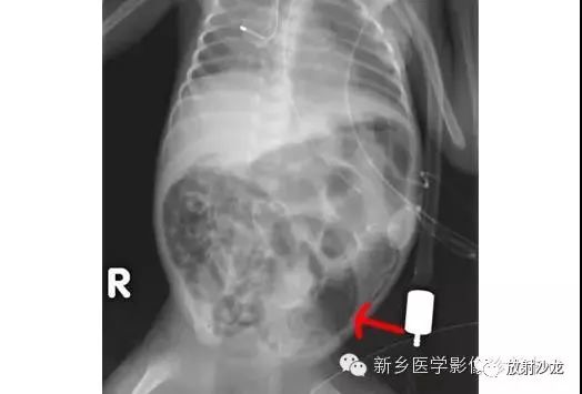 详细腹部平片解剖+正常表现+读片技巧+病例分析