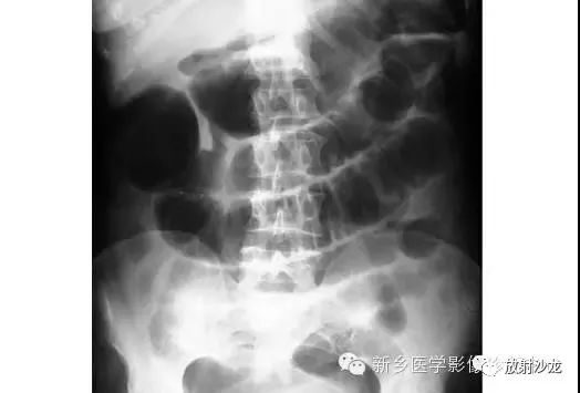 详细腹部平片解剖+正常表现+读片技巧+病例分析