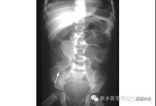 详细腹部平片解剖+正常表现+读片技巧+病例分析