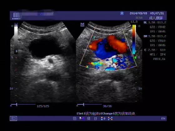 腹主动脉瘤腔内修复术多少钱,腹主动脉瘤怎么自测