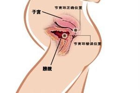 取完环二胎备孕的正式方法,备孕取环前后关注事项怎么做