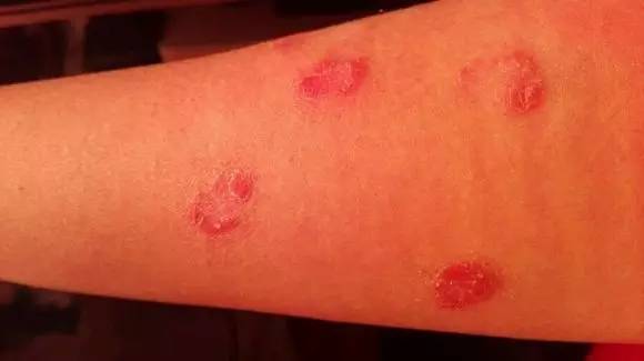 与牛皮癣抗争的十年艰辛路,牛皮癣银屑病患者福音