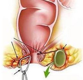 肛瘘中医诊断及鉴别,肛瘘如何诊断