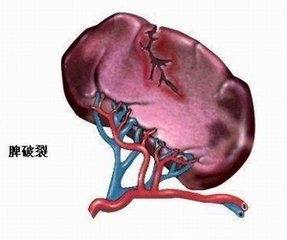 如果把脾脏切了以后会关注什么,脾脏大一定要切吗