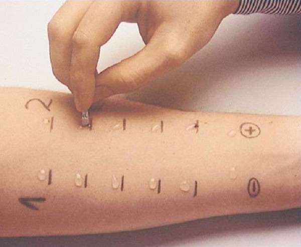 涂皮康王过敏怎么办,每天用康王过敏怎么办