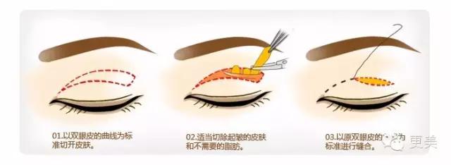 抬头纹手术会不会影响眼睛,抬头纹手术后有后遗症吗