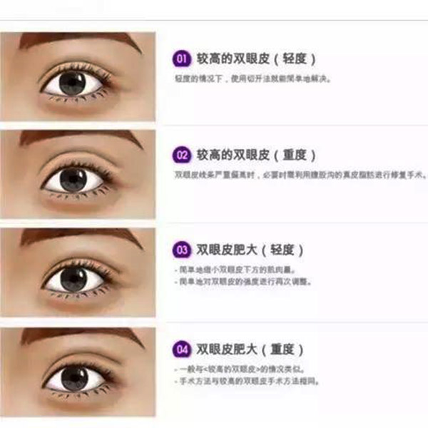 哭多了会不会死,哭会把双眼皮哭成单眼皮吗