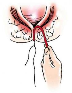 肛瘘中医诊断及鉴别,肛瘘如何诊断