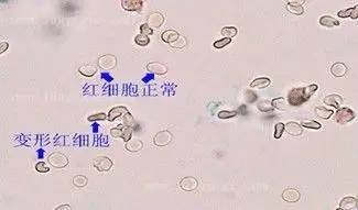 简单教你读懂尿常规|香港大学深圳医院肾内科