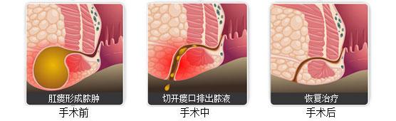 肛瘘中医诊断及鉴别,肛瘘如何诊断