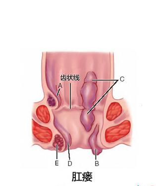 肛瘘中医诊断及鉴别,肛瘘如何诊断