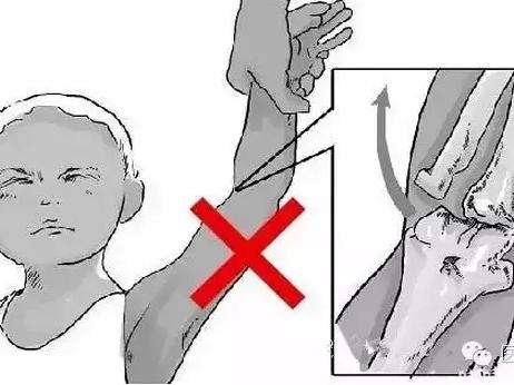 宝宝胳膊脱臼复位怎样养护,宝宝胳膊脱臼在家怎么办