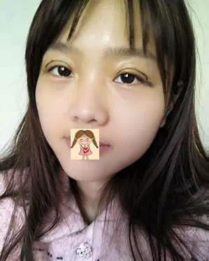 埋线双眼皮去掉线能恢复原样吗,纳米无痕双眼皮埋线怎么恢复得快