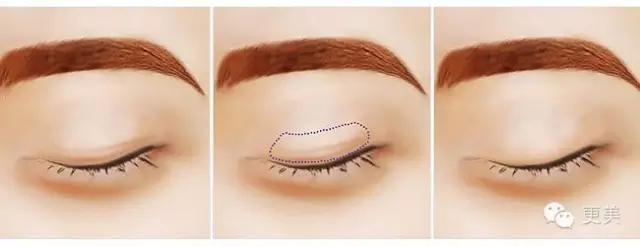 抬头纹手术会不会影响眼睛,抬头纹手术后有后遗症吗