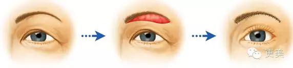 抬头纹手术会不会影响眼睛,抬头纹手术后有后遗症吗