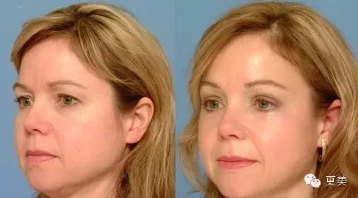 抬头纹手术会不会影响眼睛,抬头纹手术后有后遗症吗