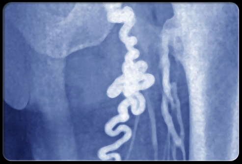 盆腔疼痛怎么引起的,盆腔疼痛是什么原因引起的