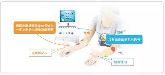 武继祥谈脑卒中康复,脑卒中康复治疗方法文献