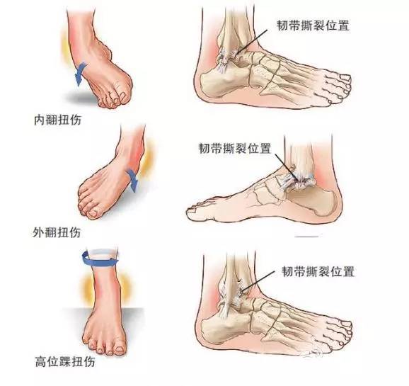 脚踝扭伤怎么办怎样按摩,脚踝扭伤怎么办幼儿园