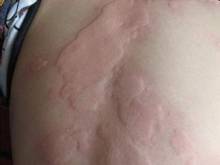 身上奇痒无比而且一大片很红,身上奇痒无比