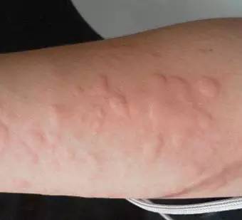 身上奇痒无比而且一大片很红,身上奇痒无比