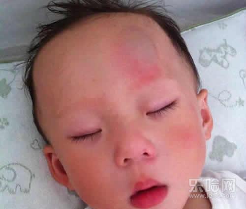 宝宝额头反复磕出大包消不掉,额头磕了个大包怎么快速消肿