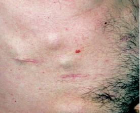 身上有小肉疙瘩会癌变吗,身上长了很多小肉粒是癌症吗