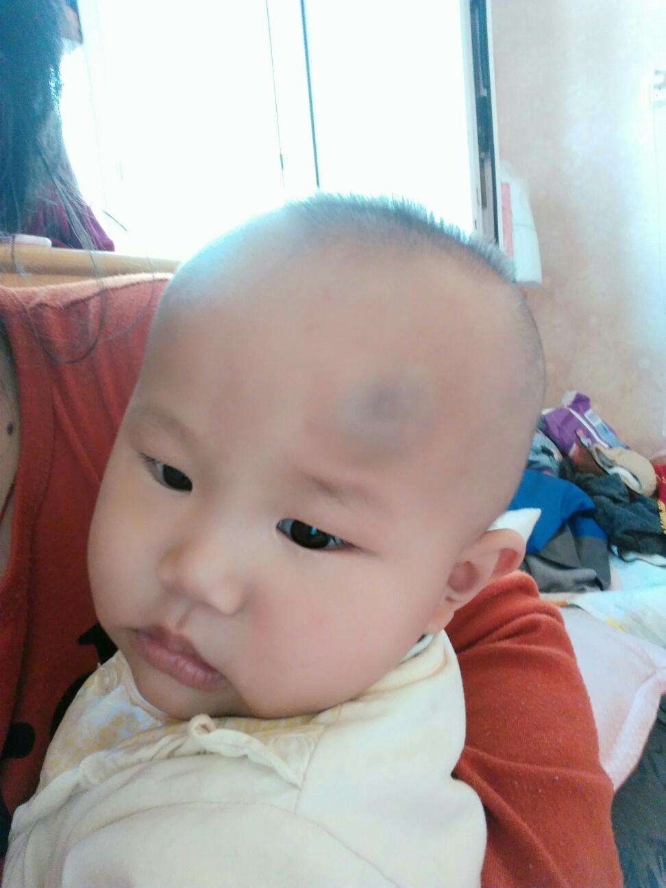 宝宝额头反复磕出大包消不掉,额头磕了个大包怎么快速消肿