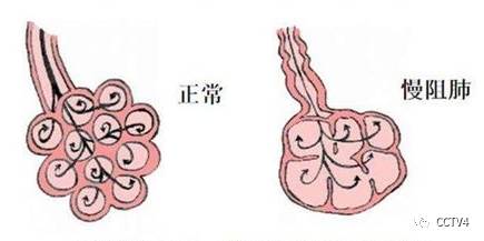 慢阻肺肺气肿怎么养肺,慢阻肺病需要补肺吗