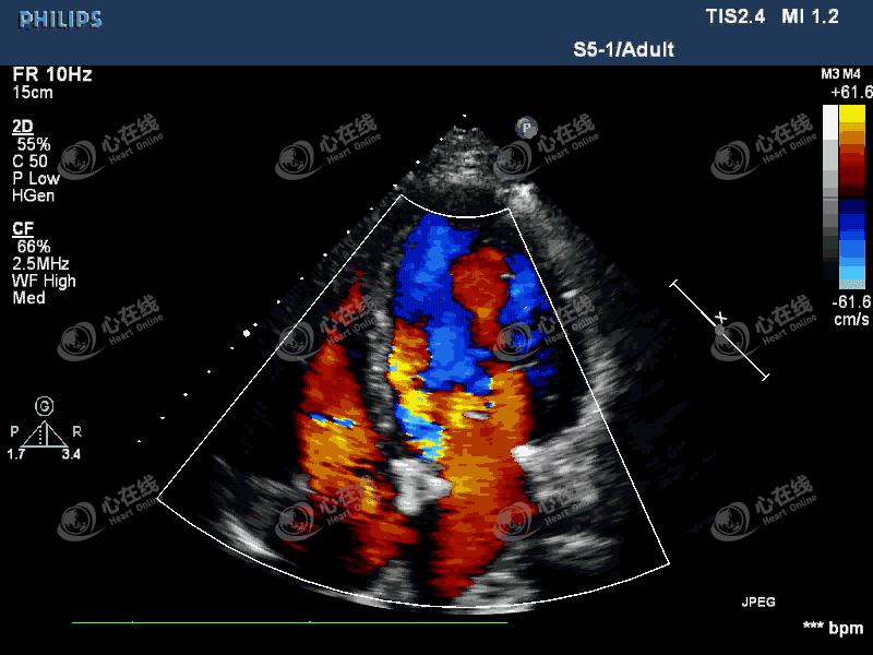 「“医”站到底」26：主动脉瓣机械瓣置换术后发热，您答对了吗？