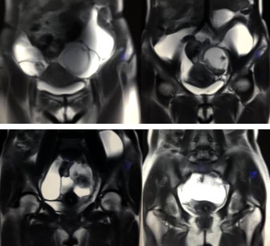 女性下腹疼痛是什么病,女性下腹疼痛的前兆