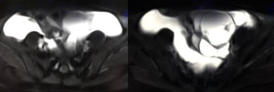 女性下腹疼痛是什么病,女性下腹疼痛的前兆