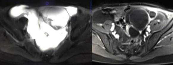 女性下腹疼痛是什么病,女性下腹疼痛的前兆