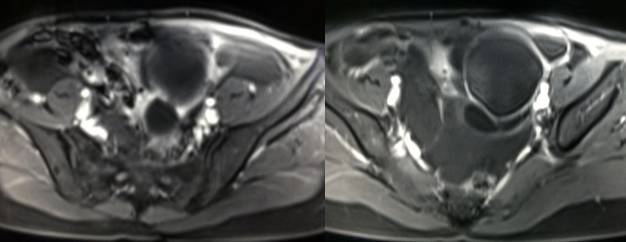 女性下腹疼痛是什么病,女性下腹疼痛的前兆