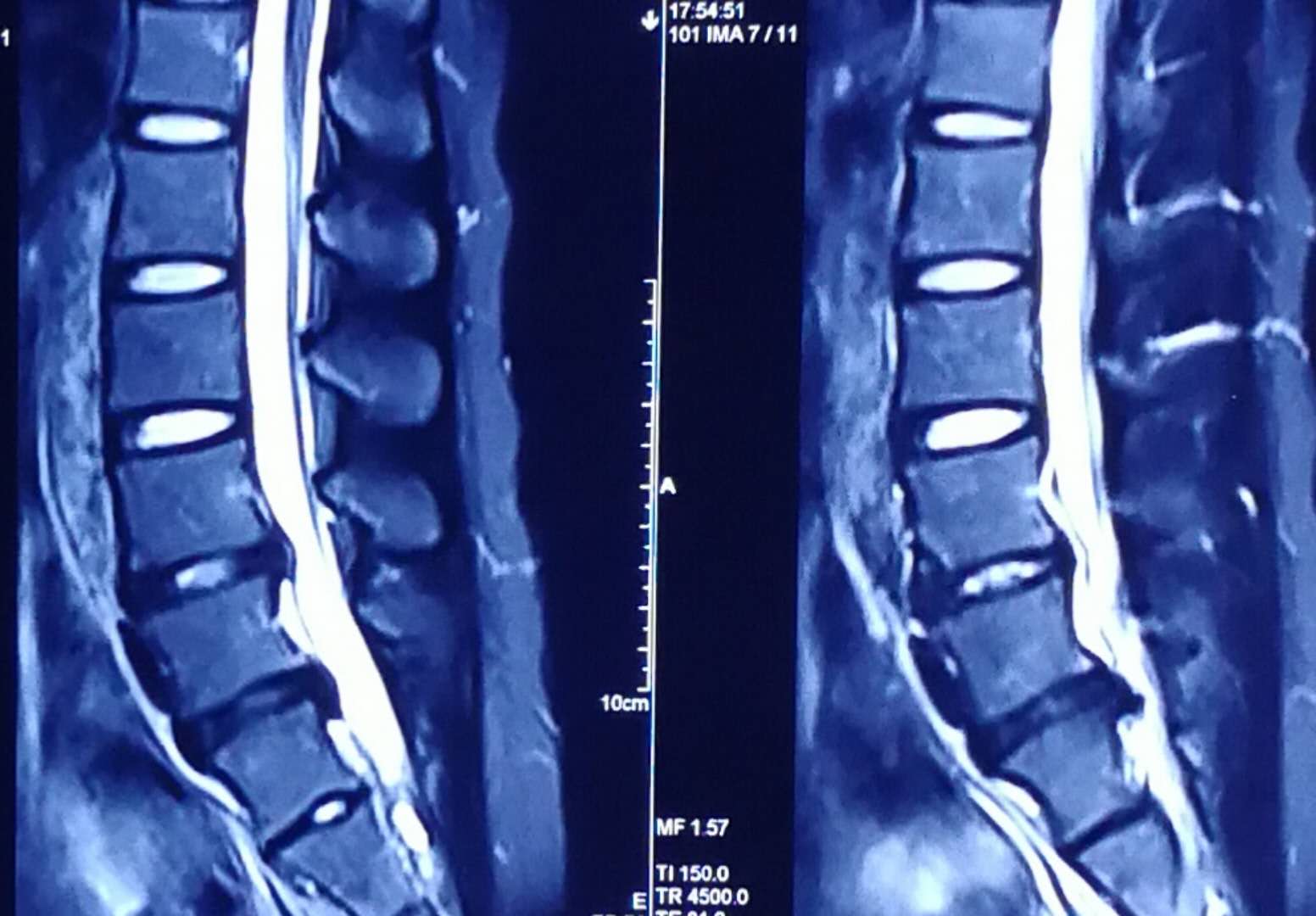 美女们，我该如何去拯救你们椎间盘突出的腰？