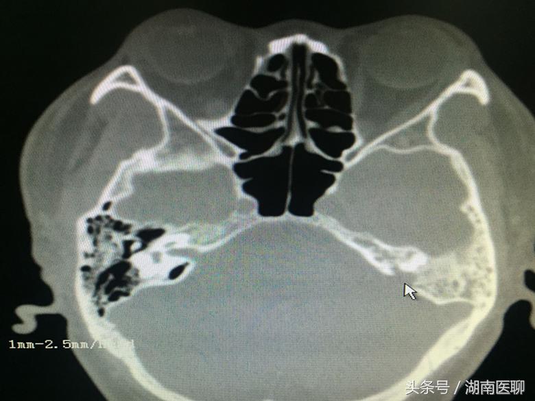 男子流鼻涕,脑膜穿孔流鼻涕