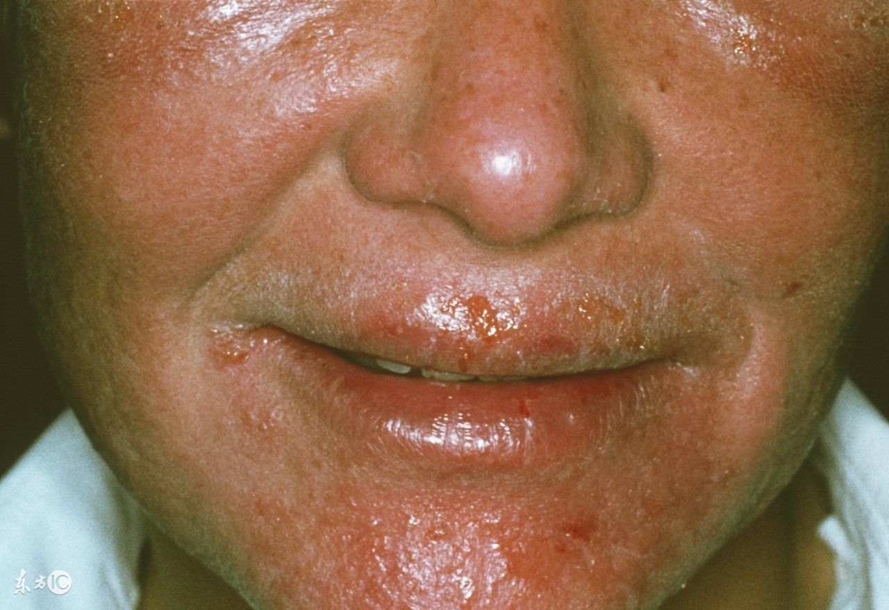 口周皮炎如何内调,口周皮炎是什么原因引起的