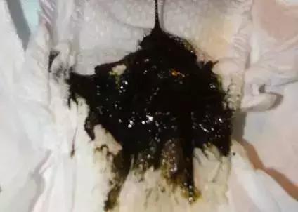 绿色便和黄色便的原因,黑绿色稀便是什么原因