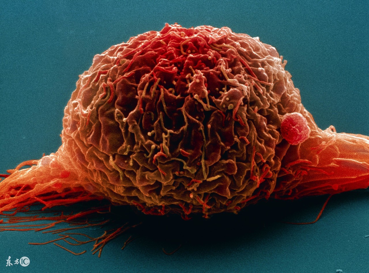 认识肾结石,认识肺癌