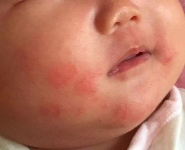 三个月口水疹最简单有效的方法,怎么预防口水疹