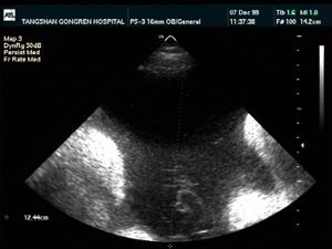 羊水破了怎么办宝宝会缺氧吗,羊水破了怎么办在家穿什么衣服