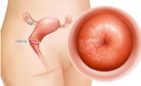 高发病率的宫颈炎患上该病真的不需要治疗吗？