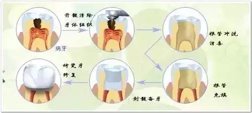 补牙期间治疗牙痛怎么办,牙医技术不好补牙之后牙痛