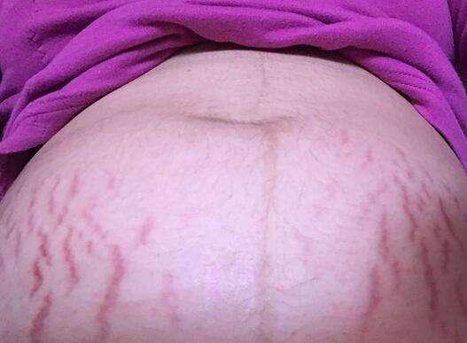 产后淡化妊娠纹最好的办法,产后妊娠纹是没有什么好方法消除